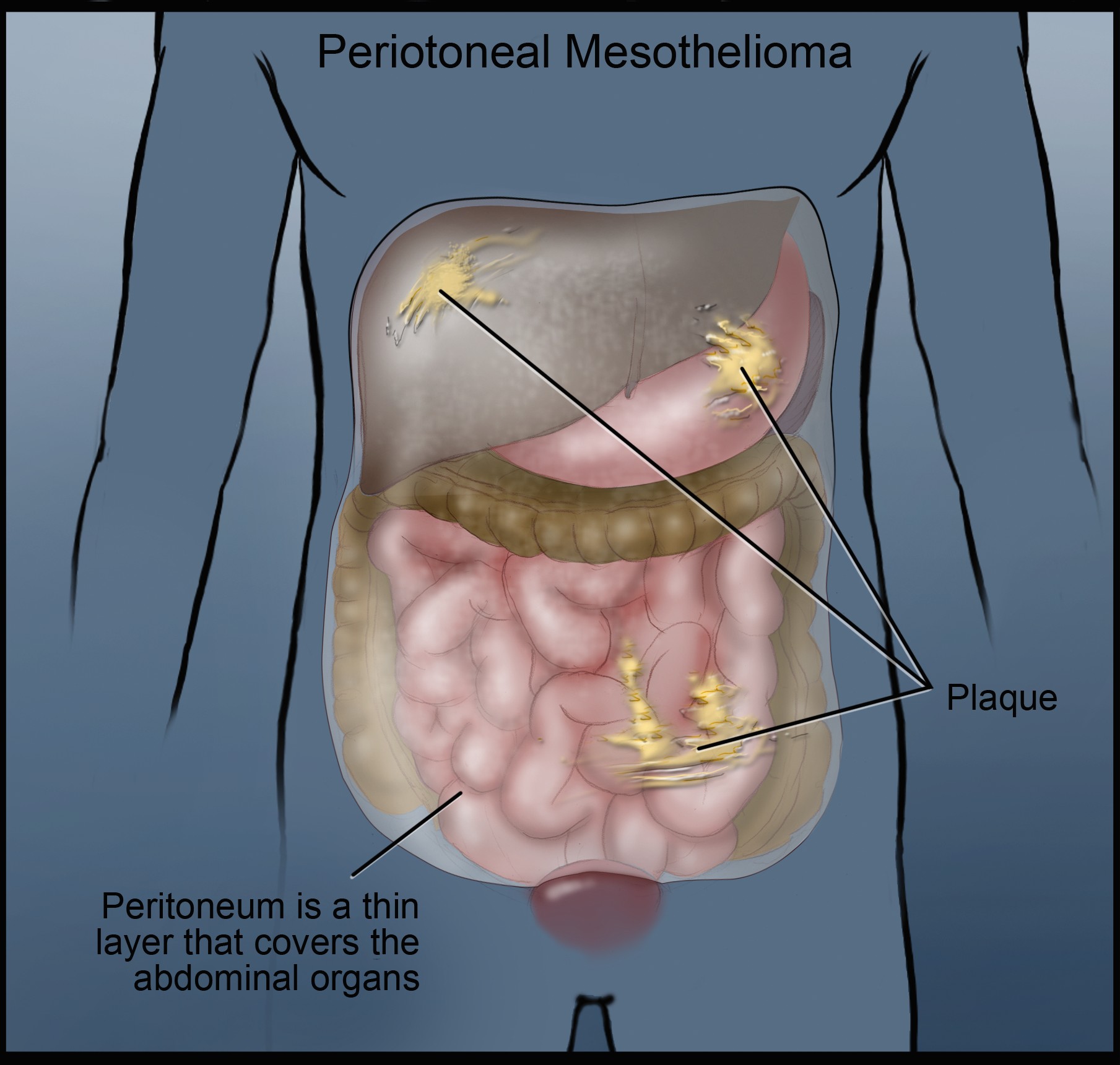 peritoneal mesothelioma