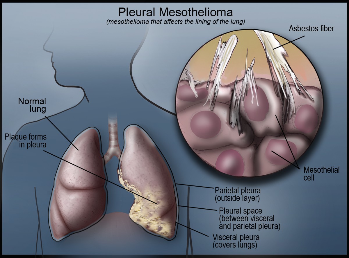 pleural mesothelioma
