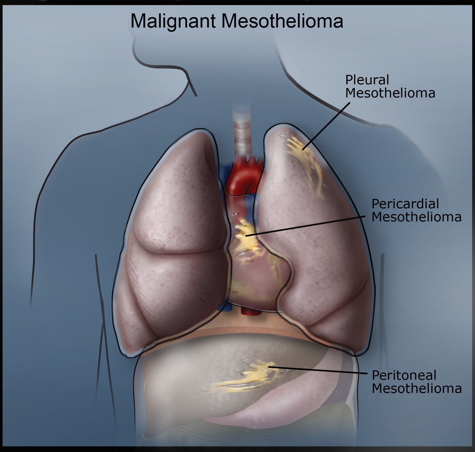 what is mesothelioma