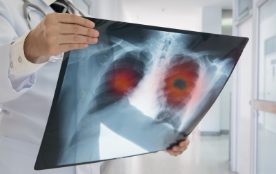 Doctor reviewing x-ray of lung cancer patient